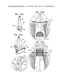 TECHNIQUES FOR PERCUTANEOUS MITRAL VALVE REPLACEMENT AND SEALING diagram and image