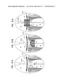 TECHNIQUES FOR PERCUTANEOUS MITRAL VALVE REPLACEMENT AND SEALING diagram and image