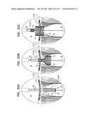 TECHNIQUES FOR PERCUTANEOUS MITRAL VALVE REPLACEMENT AND SEALING diagram and image