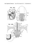 TECHNIQUES FOR PERCUTANEOUS MITRAL VALVE REPLACEMENT AND SEALING diagram and image