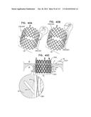 TECHNIQUES FOR PERCUTANEOUS MITRAL VALVE REPLACEMENT AND SEALING diagram and image