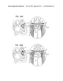 TECHNIQUES FOR PERCUTANEOUS MITRAL VALVE REPLACEMENT AND SEALING diagram and image