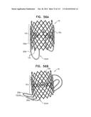 TECHNIQUES FOR PERCUTANEOUS MITRAL VALVE REPLACEMENT AND SEALING diagram and image