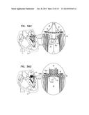 TECHNIQUES FOR PERCUTANEOUS MITRAL VALVE REPLACEMENT AND SEALING diagram and image