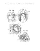 TECHNIQUES FOR PERCUTANEOUS MITRAL VALVE REPLACEMENT AND SEALING diagram and image