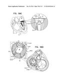 TECHNIQUES FOR PERCUTANEOUS MITRAL VALVE REPLACEMENT AND SEALING diagram and image