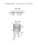 TECHNIQUES FOR PERCUTANEOUS MITRAL VALVE REPLACEMENT AND SEALING diagram and image