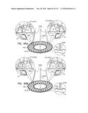 TECHNIQUES FOR PERCUTANEOUS MITRAL VALVE REPLACEMENT AND SEALING diagram and image