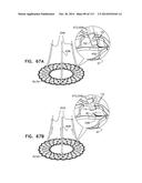 TECHNIQUES FOR PERCUTANEOUS MITRAL VALVE REPLACEMENT AND SEALING diagram and image