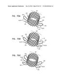 TECHNIQUES FOR PERCUTANEOUS MITRAL VALVE REPLACEMENT AND SEALING diagram and image