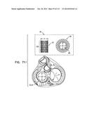 TECHNIQUES FOR PERCUTANEOUS MITRAL VALVE REPLACEMENT AND SEALING diagram and image