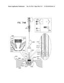 TECHNIQUES FOR PERCUTANEOUS MITRAL VALVE REPLACEMENT AND SEALING diagram and image