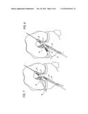 METHOD FOR CREATING A DOUBLE BUNDLE LIGAMENT ORIENTATION IN A SINGLE BONE     TUNNEL DURING KNEE LIGAMENT RECONSTRUCTION diagram and image