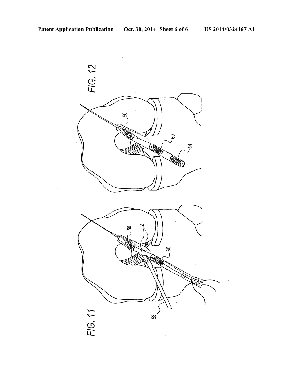 METHOD FOR CREATING A DOUBLE BUNDLE LIGAMENT ORIENTATION IN A SINGLE BONE     TUNNEL DURING KNEE LIGAMENT RECONSTRUCTION - diagram, schematic, and image 07