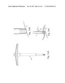 MULTI-COMPONENT NON-BIODEGRADABLE IMPLANT, A METHOD OF MAKING AND A METHOD     OF IMPLANTATION diagram and image