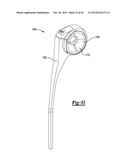 ELBOW PROSTHESIS diagram and image