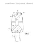 ELBOW PROSTHESIS diagram and image