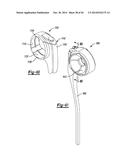 ELBOW PROSTHESIS diagram and image