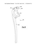 ELBOW PROSTHESIS diagram and image