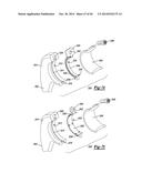 ELBOW PROSTHESIS diagram and image