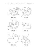 System And Method For A Bone Engaging Dental Implant Surgical Stent     Placement System diagram and image