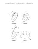 System And Method For A Bone Engaging Dental Implant Surgical Stent     Placement System diagram and image