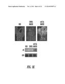 DIAGNOSIS AND TREATMENT OF TAXANE-RESISTANT CANCERS diagram and image