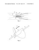 SYSTEMS AND METHODS FOR MAKING AND USING PERCUTANEOUSLY- DELIVERED PUMPING     SYSTEMS FOR PROVIDING HEMODYNAMIC SUPPORT diagram and image