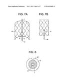 Use of an Expandable Stent as an Implant Conduit in the Lateral Approach     to the Spine diagram and image