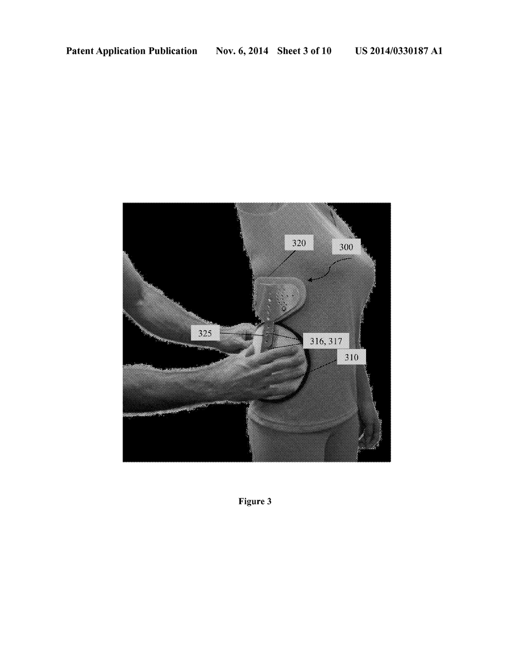 Scoliosis Brace - diagram, schematic, and image 04