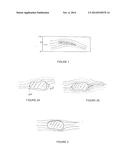 METHOD OF ABLATING SCAR TISSUE TO ORIENT ELECTRICAL CURRENT FLOW diagram and image