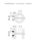 FLEXIBLE PLATE FIXATION OF BONE FRACTURES diagram and image