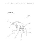 METHODS AND APPARATUSES FOR TREATING TONSILS diagram and image