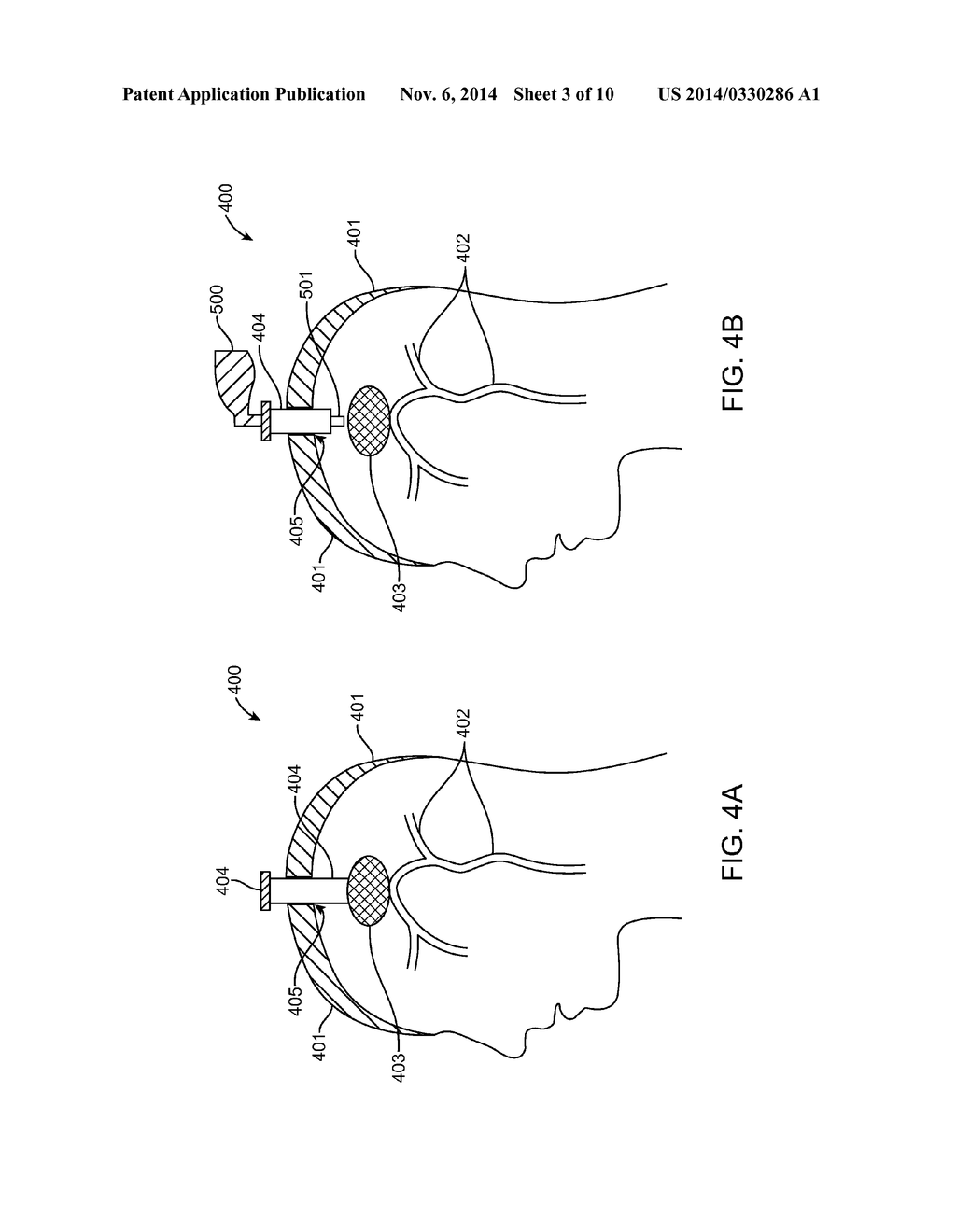 Methods and Devices for Removing Obstructing Material From the Human Body - diagram, schematic, and image 04