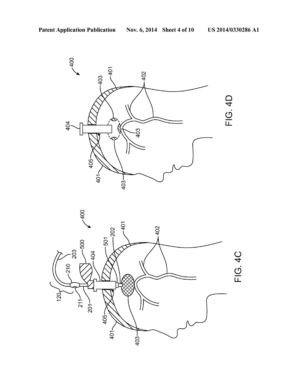 Methods and Devices for Removing Obstructing Material From the Human Body - diagram, schematic, and image 05