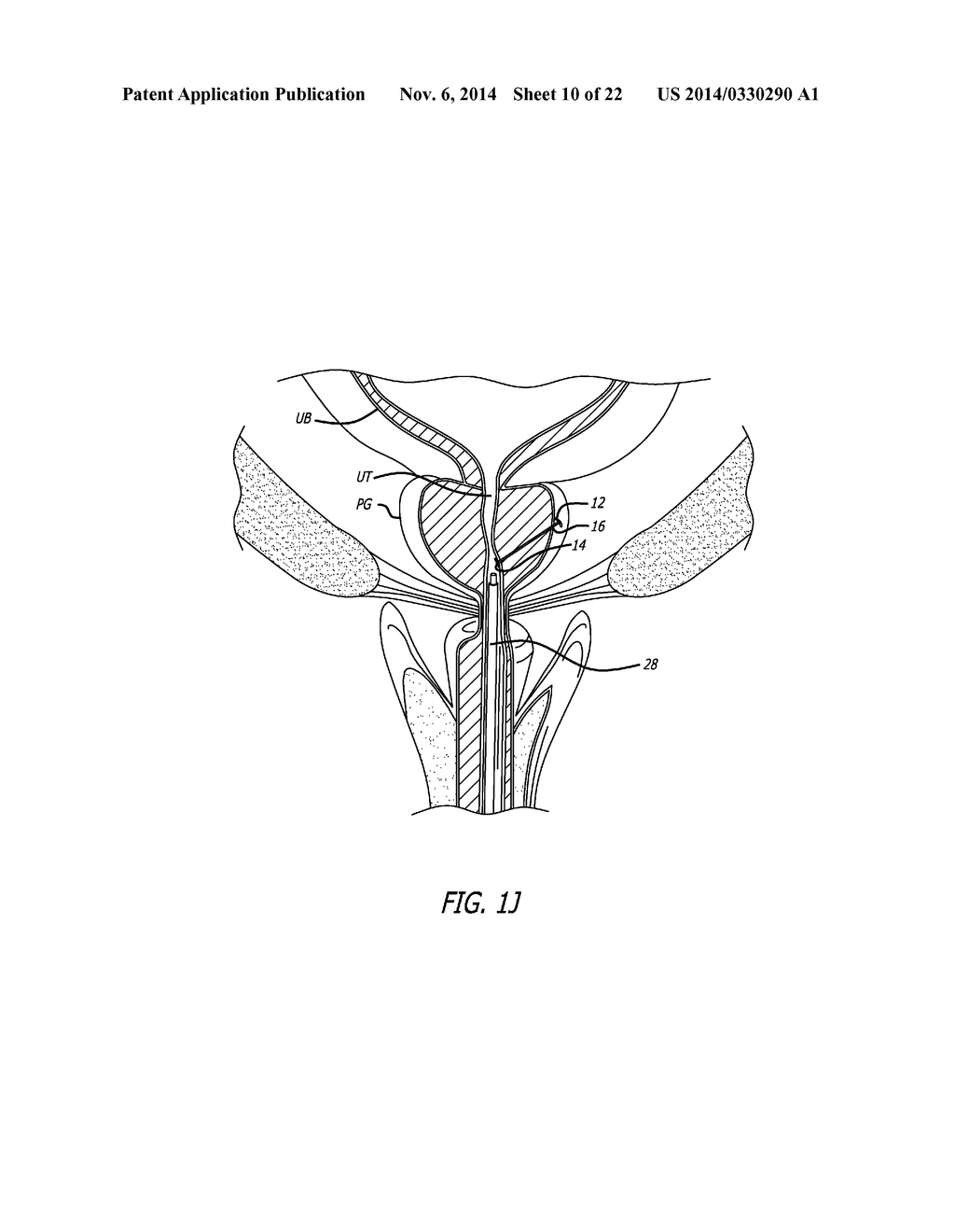 System for Delivering an Anchor - diagram, schematic, and image 11