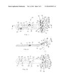 METHOD OF STABILIZING A FRACTURE AT A METAPHYSIS DEFINING A CONCAVE     ARTICULAR SURFACE diagram and image