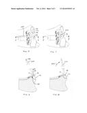 METHOD OF STABILIZING A FRACTURE AT A METAPHYSIS DEFINING A CONCAVE     ARTICULAR SURFACE diagram and image