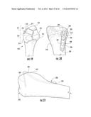 COMBINATION HOLDER/IMPACTOR AND BONE PLATE FOR FRACTURE FIXATION diagram and image