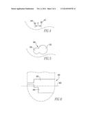 DOUBLE-LOOP ENDOBUTTON, OVOID TUNNEL GUIDE, AND METHOD OF ACL     RE-CONSTRUCTION USING THE OVOID TUNNEL GUIDE AND THE DOUBLE-LOOP     ENDOBUTTON diagram and image