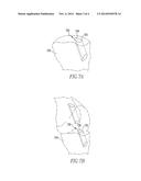 DOUBLE-LOOP ENDOBUTTON, OVOID TUNNEL GUIDE, AND METHOD OF ACL     RE-CONSTRUCTION USING THE OVOID TUNNEL GUIDE AND THE DOUBLE-LOOP     ENDOBUTTON diagram and image