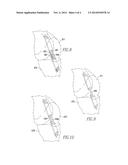 DOUBLE-LOOP ENDOBUTTON, OVOID TUNNEL GUIDE, AND METHOD OF ACL     RE-CONSTRUCTION USING THE OVOID TUNNEL GUIDE AND THE DOUBLE-LOOP     ENDOBUTTON diagram and image