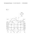 ARTIFICIAL KNEE JOINT IMPLANT diagram and image