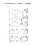 ARTIFICIAL KNEE JOINT IMPLANT diagram and image