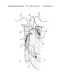 ORAL SLEEP APNOEA DEVICE diagram and image