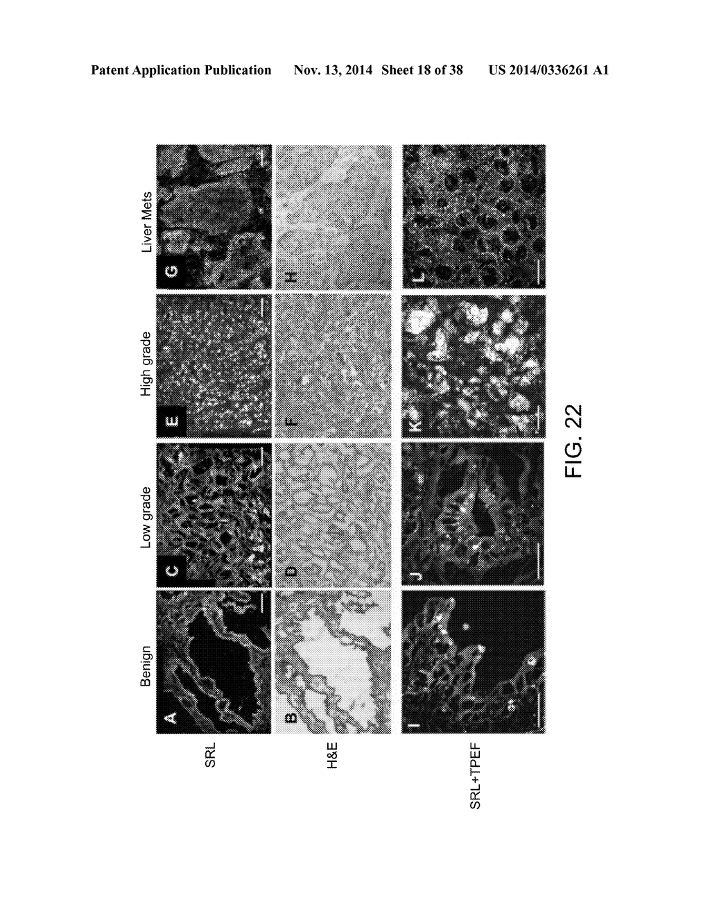 METHODS FOR DETERMINING AGGRESSIVENESS OF A CANCER AND TREATMENT THEREOF - diagram, schematic, and image 19