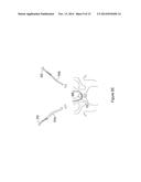 SYSTEMS AND METHODS EMPLOYING A PUSH TUBE FOR DELIVERING A URETHRAL SLING diagram and image