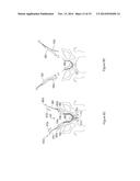 SYSTEMS AND METHODS EMPLOYING A PUSH TUBE FOR DELIVERING A URETHRAL SLING diagram and image
