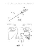 DEVICES AND METHODS FOR THE RAPID AND ACCURATE DIAGNOSIS AND TREATMENT OF     SINUSITIS diagram and image