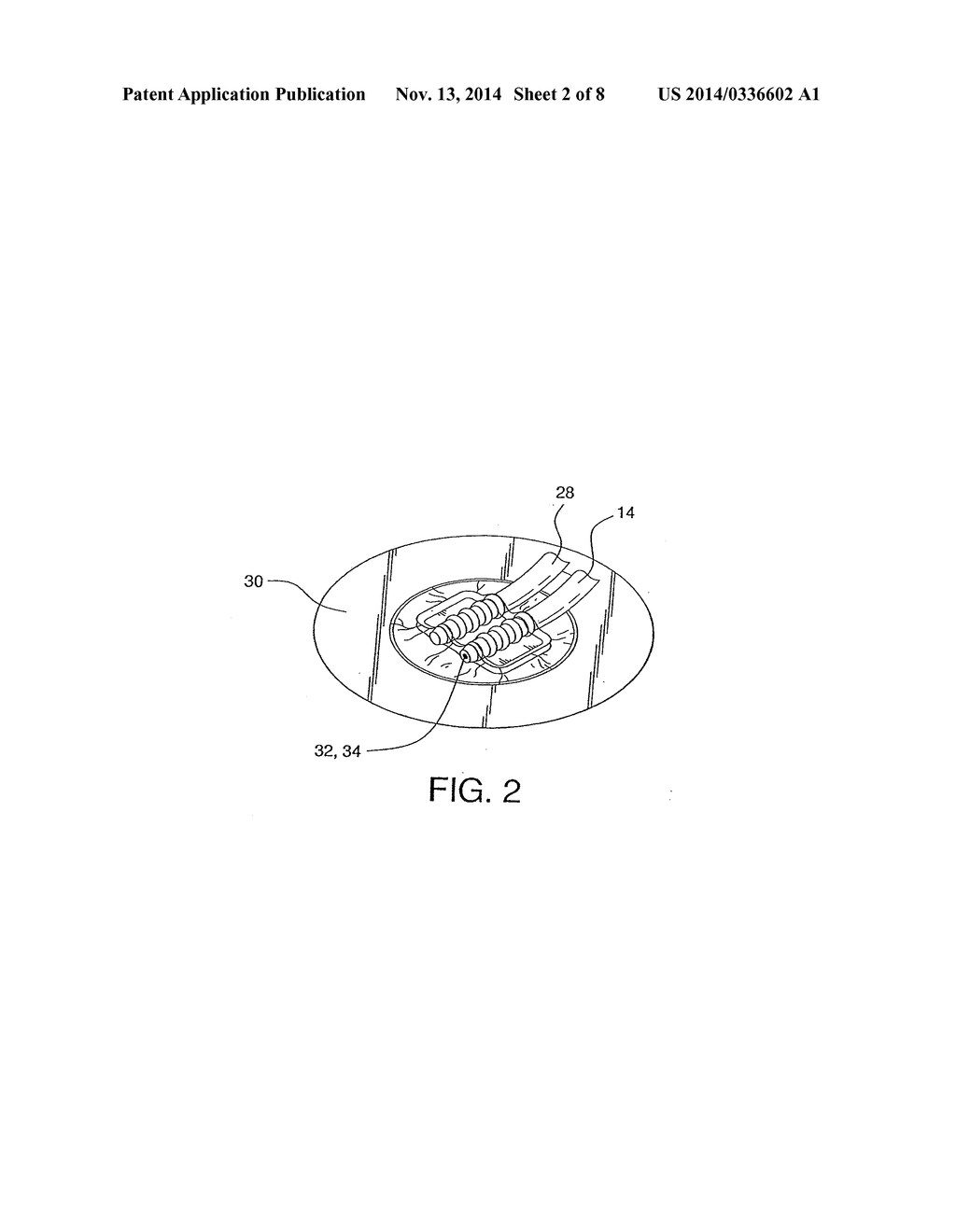 SYSTEM FOR TREATING A WOUND WITH SUCTION AND METHOD OF DETECTING A LOSS OF     SUCTION - diagram, schematic, and image 03